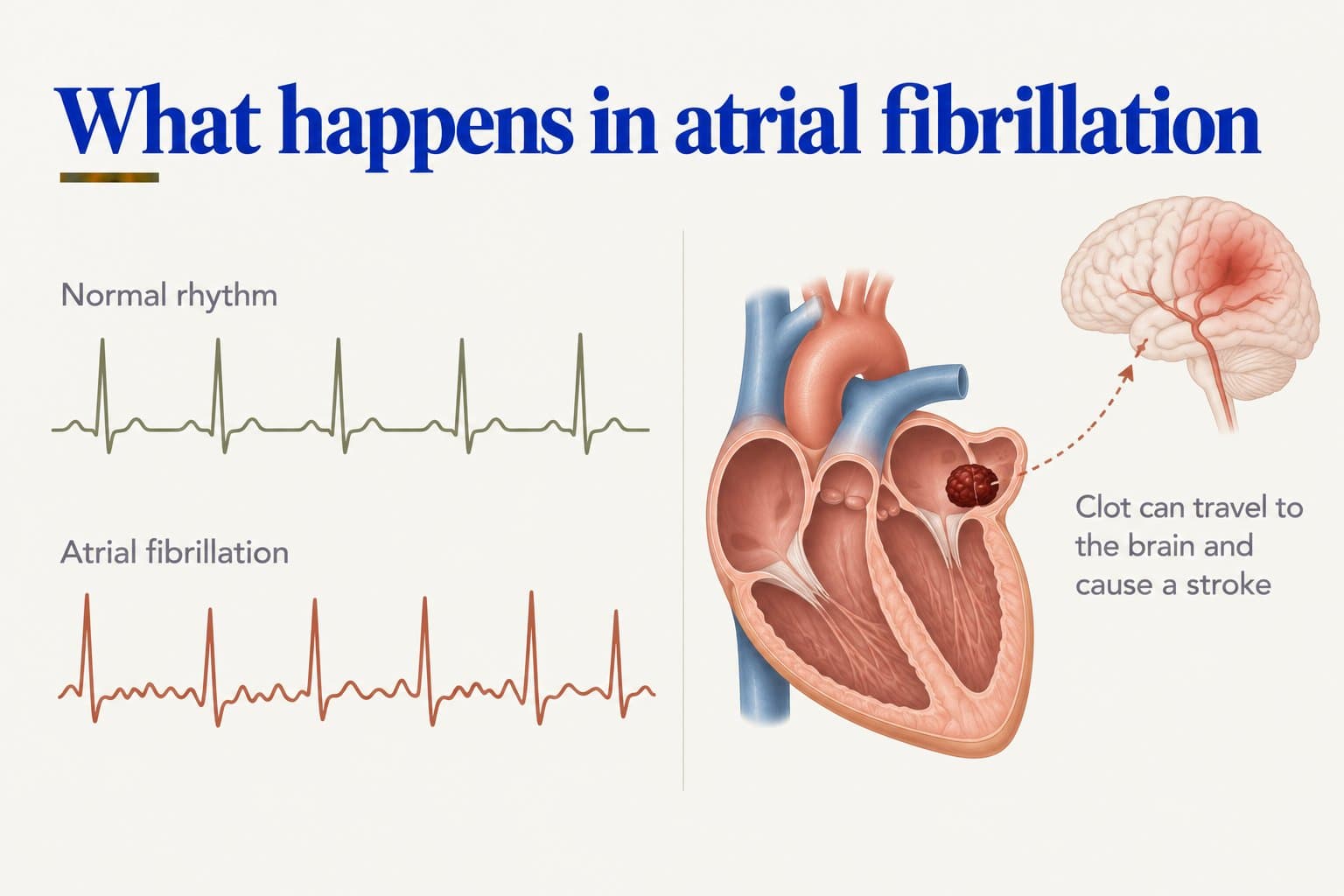 Diagram, what happens in atrial fibrillation: a regular normal-rhythm ECG trace compared with the irregular, chaotic trace of atrial fibrillation, and a heart with a clot in the left atrium that can travel to the brain and cause a stroke