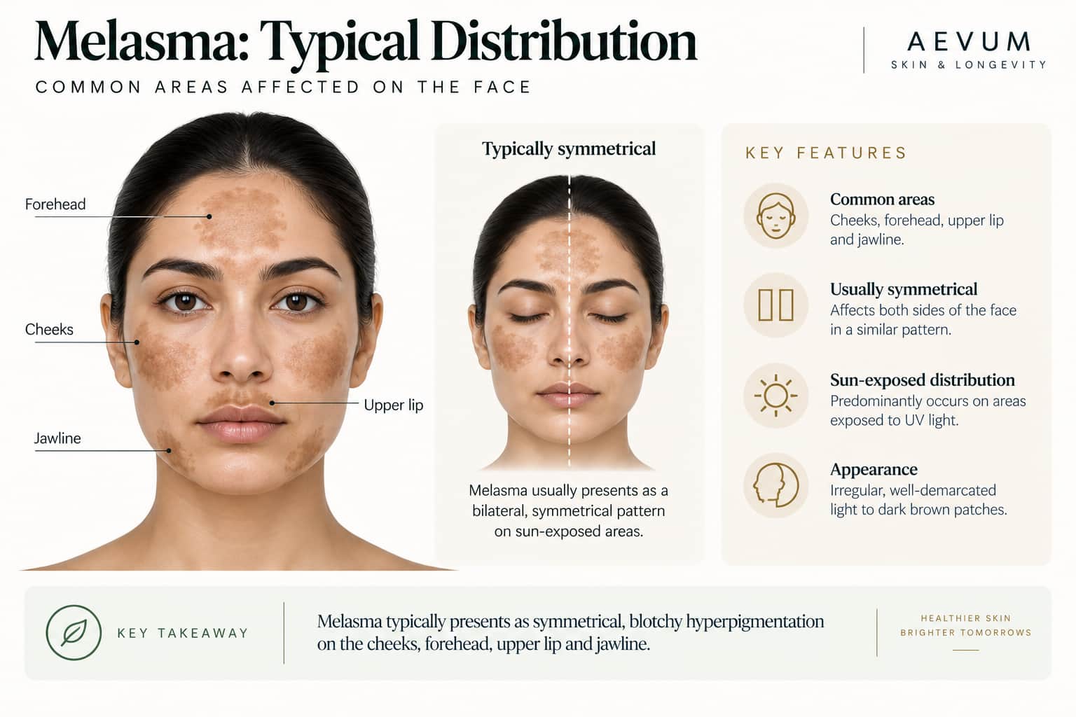 A comparison illustrating typical melasma distribution on the face — cheeks, forehead, upper lip, and jawline — alongside a description of its characteristic symmetric pattern