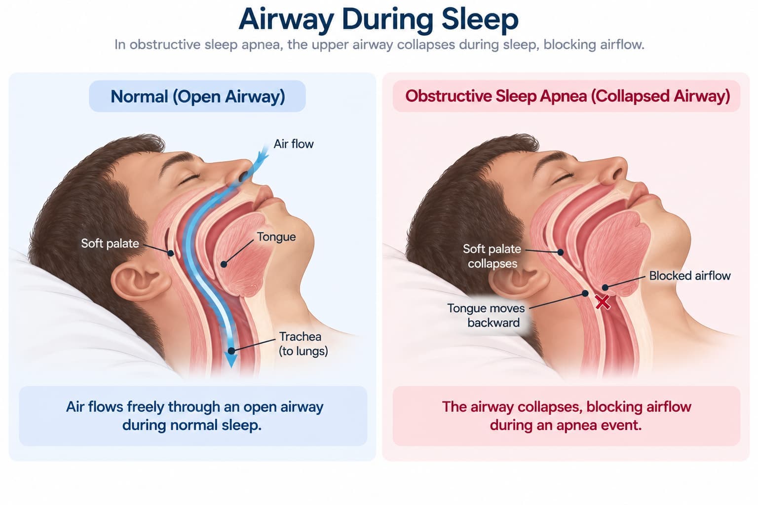 A diagram illustrating airway collapse during an apnea event, contrasted with a normal open airway