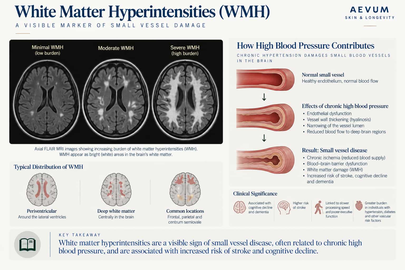Diagram showing increasing white matter hyperintensity burden on brain MRI scans, alongside how chronic high blood pressure damages small vessels through endothelial dysfunction and vessel wall thickening, leading to small vessel disease