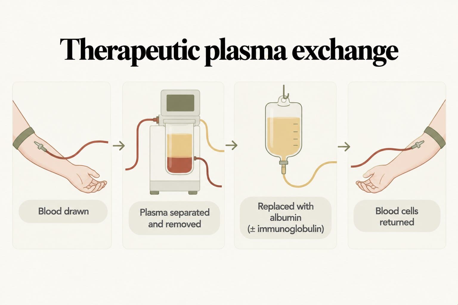 Four-step diagram, therapeutic plasma exchange: blood is drawn, plasma is separated and removed, it is replaced with albumin (with or without immunoglobulin), and blood cells are returned