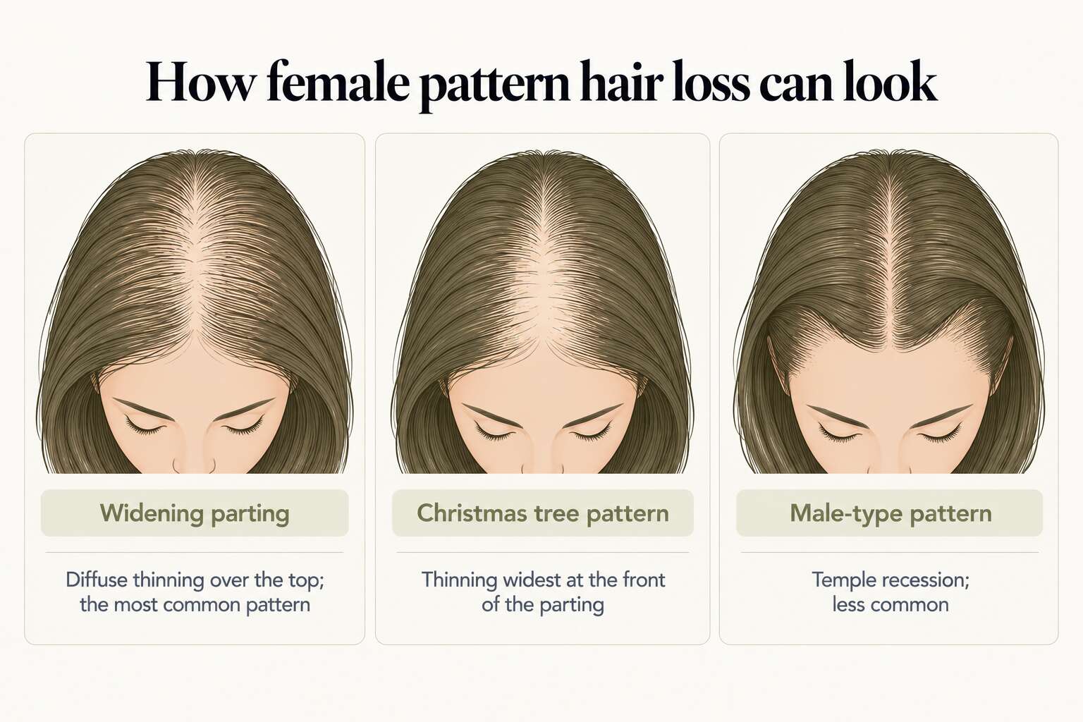 How female pattern hair loss can look: a widening parting with diffuse thinning over the top, the most common pattern; a Christmas tree pattern with thinning widest at the front of the parting; and a less common male-type pattern with temple recession