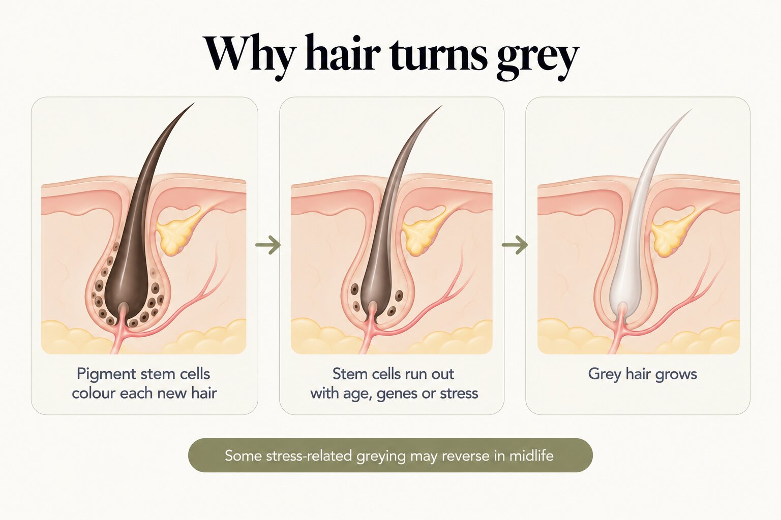 Why hair turns grey: pigment stem cells colour each new hair; the stem cells run out with age, genes or stress; grey hair grows. Some stress-related greying may reverse in midlife