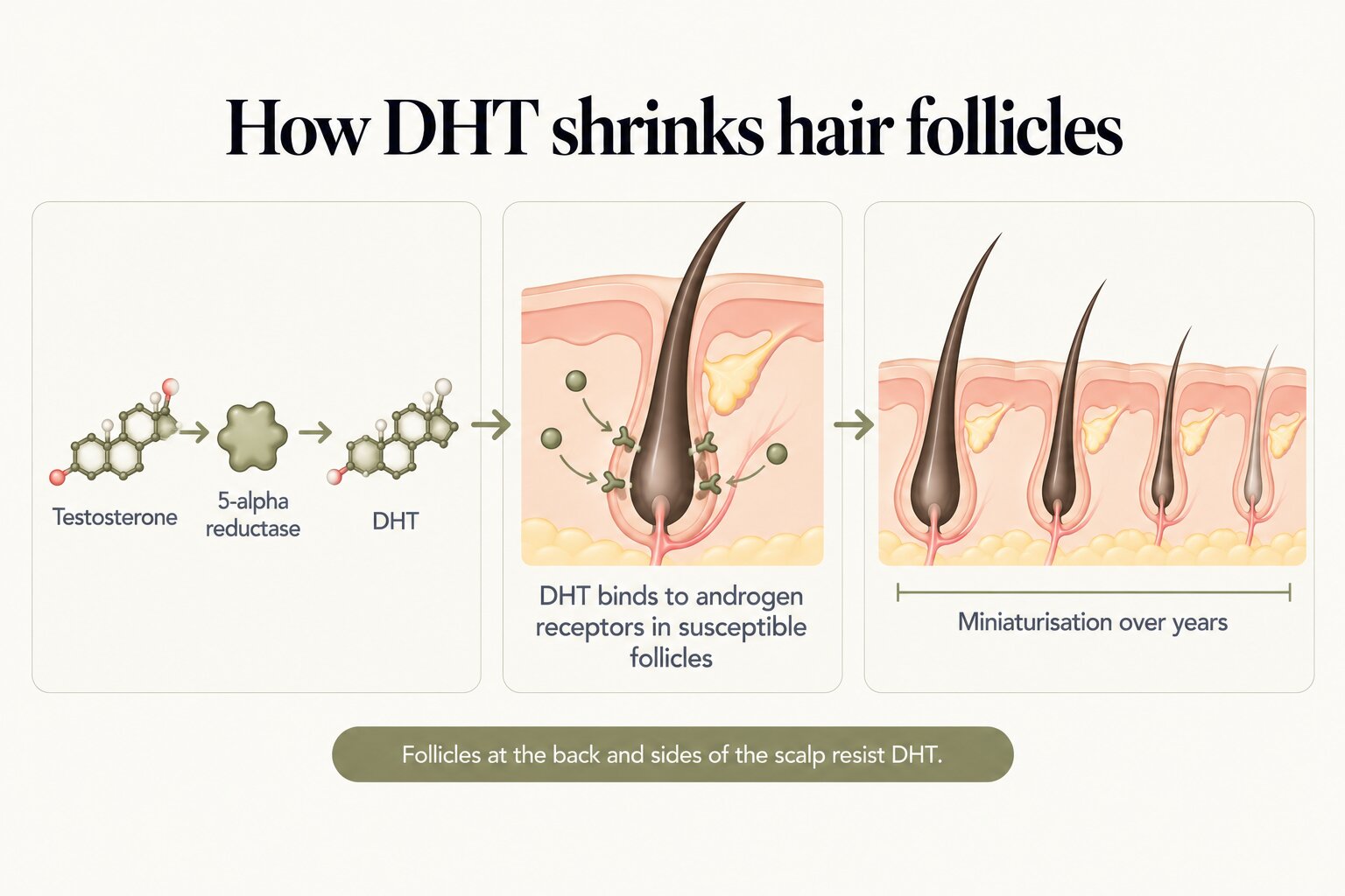 How DHT shrinks hair follicles: testosterone is converted by 5-alpha reductase into DHT, DHT binds to androgen receptors in susceptible follicles, and over years the follicles miniaturise to produce thinner, shorter and lighter hairs. Follicles at the back and sides of the scalp resist DHT