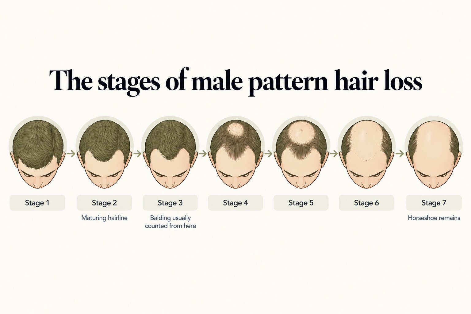 The stages of male pattern hair loss on the Norwood scale, from stage 1 with no significant loss, through stage 2 maturing hairline and stage 3 where balding is usually counted from, to stage 7 where only a horseshoe of hair remains